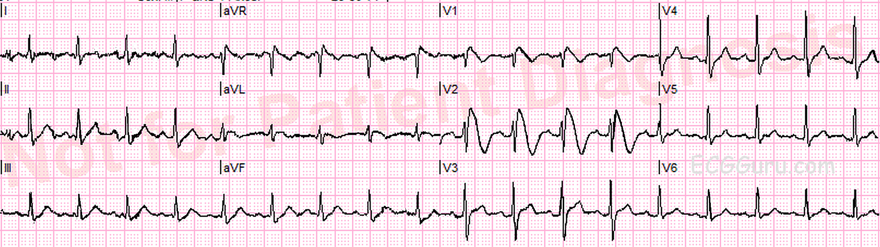 Brugada Pattern ECG Guru Instructor Resources